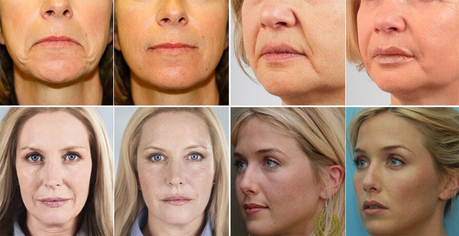 चेहरे की त्वचा कायाकल्प से पहले और बाद में महिलाओं की तस्वीरें